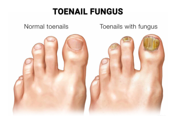 Understanding Toenail Fungus: Causes, Symptoms, And Treatment ...